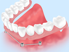 その5：マグフィット（歯科用磁石）使用した義歯