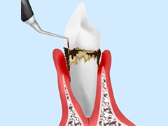 虫歯、歯周病になりやすい