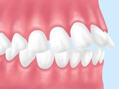 虫歯、歯周病になりやすい